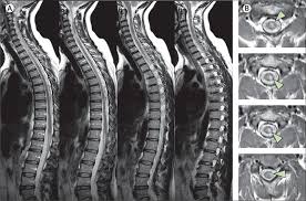 spine xray