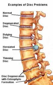 spinal issues